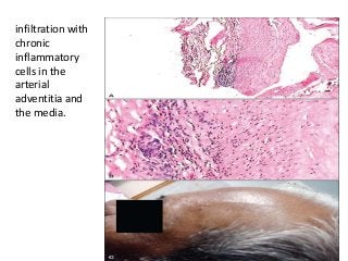 infiltration with
chronic
inflammatory
cells in the
arterial
adventitia and
the media.
 