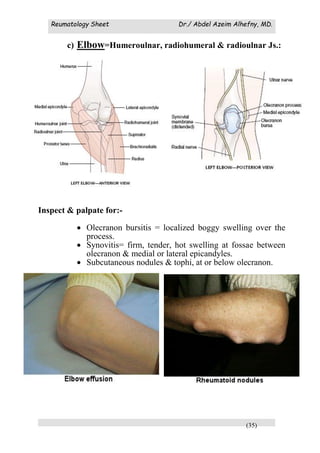 Reumatology Sheet Dr./ Abdel Azeim Alhefny, MD.
(35)
c) Elbow=Humeroulnar, radiohumeral & radioulnar Js.:
Inspect & palpate for:-
 Olecranon bursitis = localized boggy swelling over the
process.
 Synovitis= firm, tender, hot swelling at fossae between
olecranon & medial or lateral epicandyles.
 Subcutaneous nodules & tophi, at or below olecranon.
 