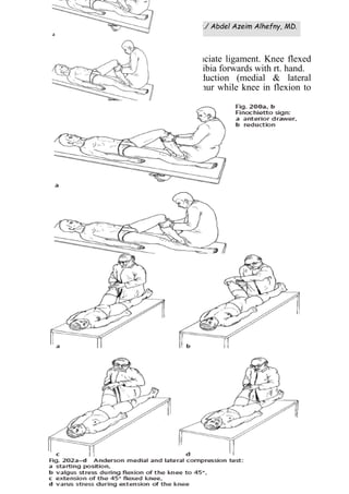 Reumatology Sheet Dr./ Abdel Azeim Alhefny, MD.
(41)
Stability:
Lachman’s test =integrity of anterior cruciate ligament. Knee flexed
20, femur grasped with lt. hand & pulling tibia forwards with rt. hand.
Collateral ligaments: abduction & adduction (medial & lateral
displacement) stretch between tibia & femur while knee in flexion to
elicit any movement.
 
