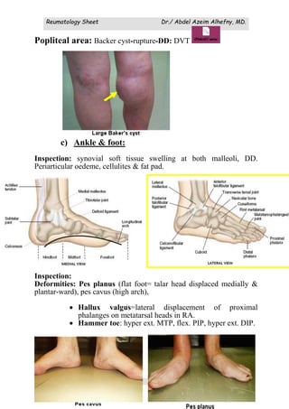 Reumatology Sheet Dr./ Abdel Azeim Alhefny, MD.
(42)
Popliteal area: Backer cyst-rupture-DD: DVT
c) Ankle & foot:
Inspection: synovial soft tissue swelling at both malleoli, DD.
Periarticular oedeme, cellulites & fat pad.
Inspection:
Deformities: Pes planus (flat foot= talar head displaced medially &
plantar-ward), pes cavus (high arch),
 Hallux valgus=lateral displacement of proximal
phalanges on metatarsal heads in RA.
 Hammer toe: hyper ext. MTP, flex. PIP, hyper ext. DIP.
 