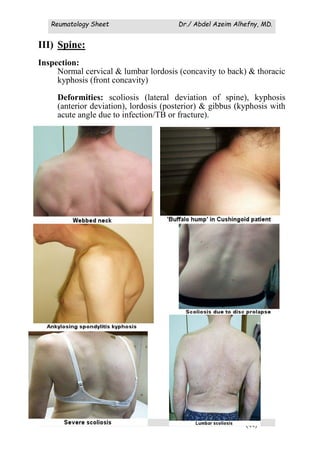 Reumatology Sheet Dr./ Abdel Azeim Alhefny, MD.
(44)
III) Spine:
Inspection:
Normal cervical & lumbar lordosis (concavity to back) & thoracic
kyphosis (front concavity)
Deformities: scoliosis (lateral deviation of spine), kyphosis
(anterior deviation), lordosis (posterior) & gibbus (kyphosis with
acute angle due to infection/TB or fracture).
 