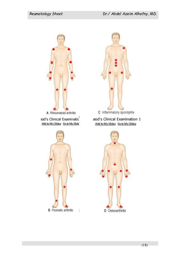 What is sbe arthritis