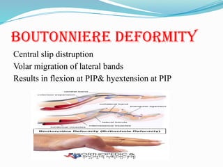 Pip Volar Injection RHEUMATOUD ARTHRITIS PRESENTATION_111926.pptx
