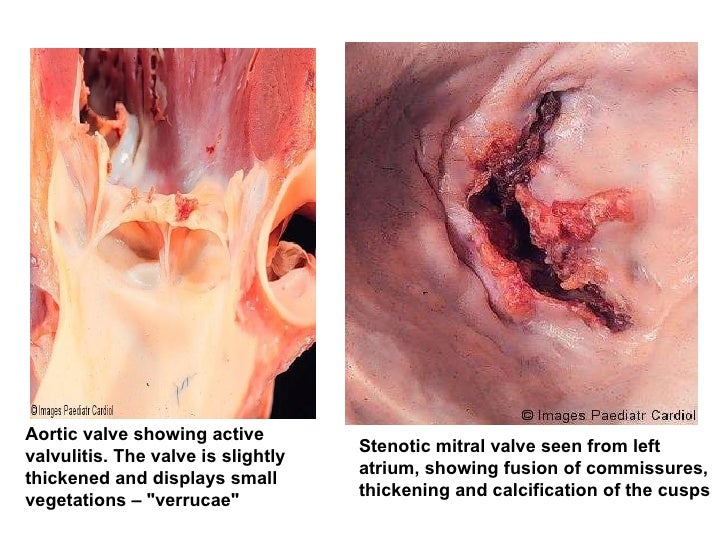 Rheumatic heart disease