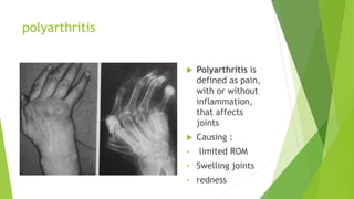 polyarthritis
 Polyarthritis is
defined as pain,
with or without
inflammation,
that affects
joints
 Causing :
• limited ROM
• Swelling joints
• redness
 