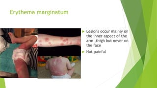 Erythema marginatum
 Lesions occur mainly on
the inner aspect of the
arm ,thigh but never on
the face
 Not painful
 