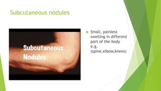 Subcutaneous nodules
 Small, painless
swelling in different
part of the body
e.g.
(spine,elbow,knees)
 