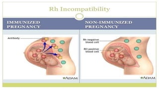 Rh incompatibility | PPTX
