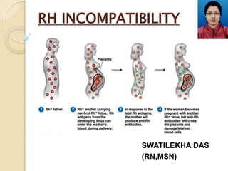 RH INCOMPATIBILITY
SWATILEKHA DAS
(RN,MSN)
 