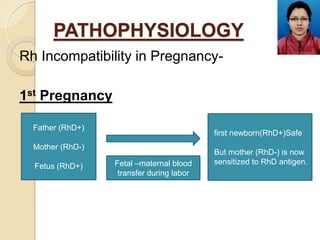 PATHOPHYSIOLOGY
Rh Incompatibility in Pregnancy-
1st Pregnancy
Father (RhD+)
Mother (RhD-)
Fetus (RhD+)
first newborn(RhD+...