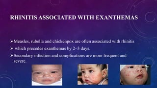 RHINITIS ASSOCIATED WITH EXANTHEMAS
Measles, rubella and chickenpox are often associated with rhinitis
 which precedes exanthemas by 2–3 days.
Secondary infection and complications are more frequent and
severe.
 