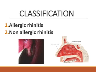CLASSIFICATION
1.Allergic rhinitis
2.Non allergic rhinitis
 