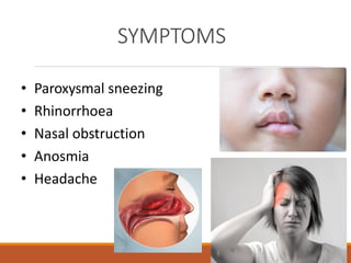 SYMPTOMS
• Paroxysmal sneezing
• Rhinorrhoea
• Nasal obstruction
• Anosmia
• Headache
 
