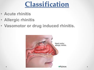 Rhinitis | PPTX