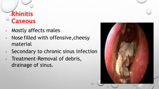 Rhinitis.pptx
