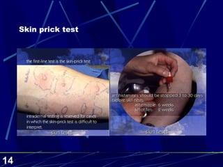 Skin prick test 