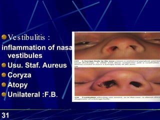 Vestibulitis  : inflammation of nasal vestibules Usu. Staf. Aureus Coryza Atopy Unilateral :F.B . 