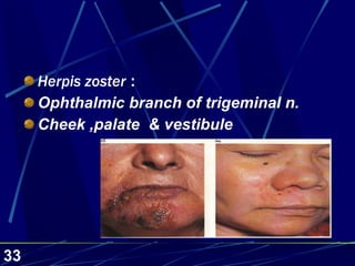Herpis zoster  : Ophthalmic branch of trigeminal n. Cheek ,palate  & vestibule 