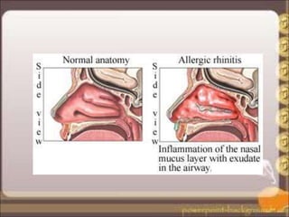 Jenis Rhinitis Rhinitis_Alergi_ppt.ppt