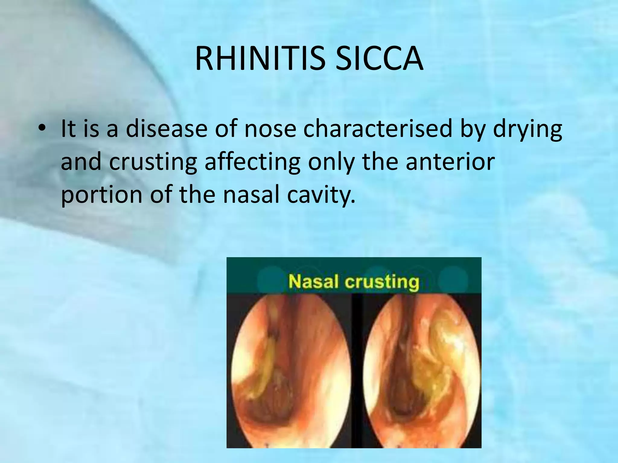 Rhinitis | PPTX