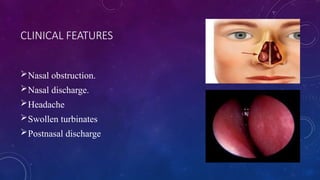 acute and chronic rhinitis by dr supriya | PPTX