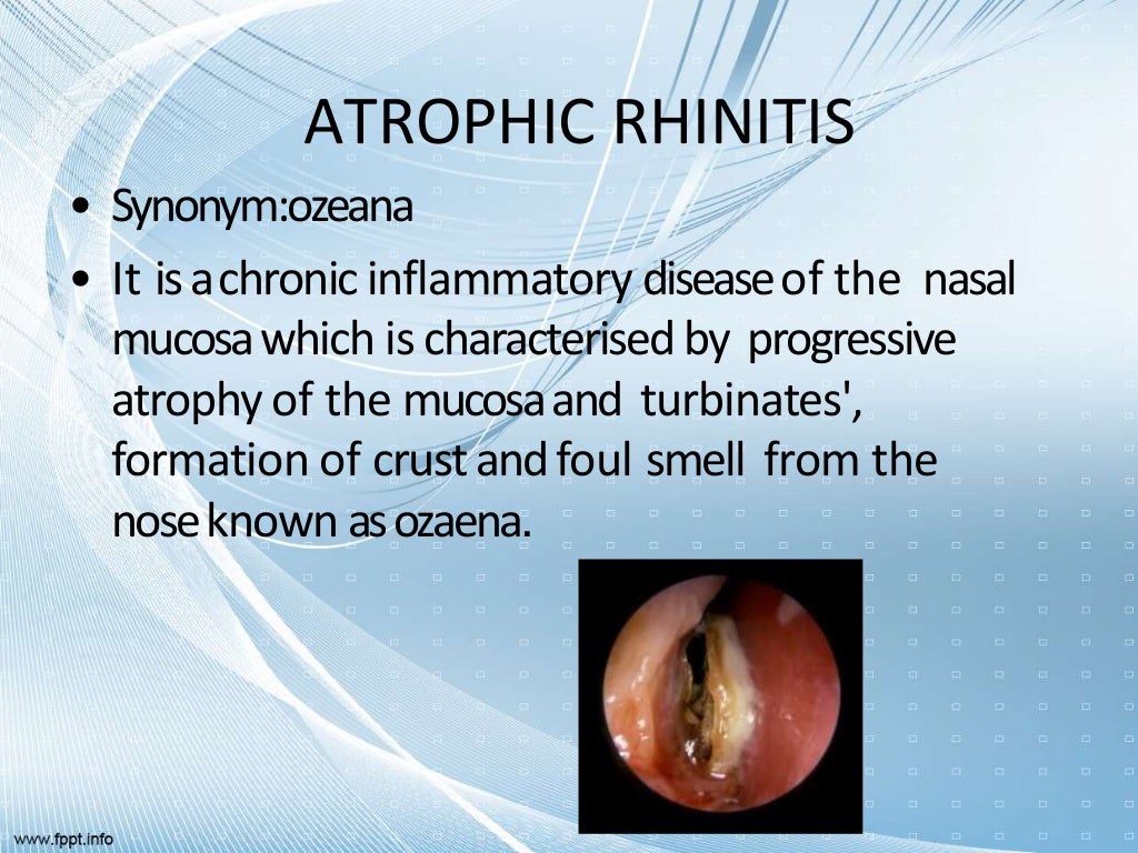 Rhinitis types