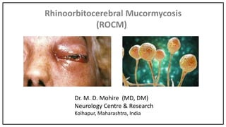 Rhinoorbitocerebral Mucormycosis
(ROCM)
Dr. M. D. Mohire (MD, DM)
Neurology Centre & Research
Kolhapur, Maharashtra, India
 