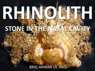 RHINOLITH
STONE IN THE NASAL CAVITY
BRIG ANWAR UL HAQ
 