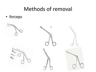 Methods of removal
• forceps
 