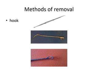 Methods of removal
• hook
 