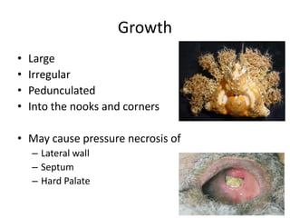 Growth
• Large
• Irregular
• Pedunculated
• Into the nooks and corners
• May cause pressure necrosis of
– Lateral wall
– Septum
– Hard Palate
 