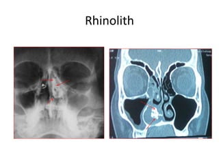 Rhinolith
 