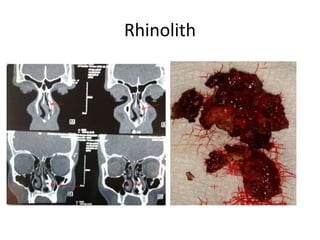 Rhinolith
 