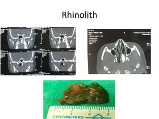 Rhinolith
 