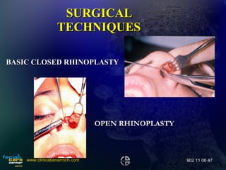 SURGICAL TECHNIQUES BASIC CLOSED RHINOPLASTY OPEN RHINOPLASTY www.clinicabenarroch.com 902 11 06 47 