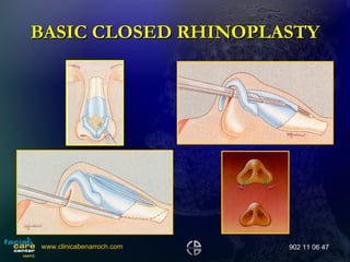 BASIC CLOSED RHINOPLASTY www.clinicabenarroch.com 902 11 06 47 