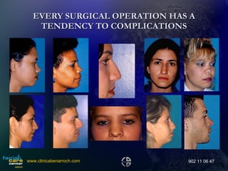 EVERY SURGICAL OPERATION HAS A TENDENCY TO COMPLICATIONS www.clinicabenarroch.com 902 11 06 47 