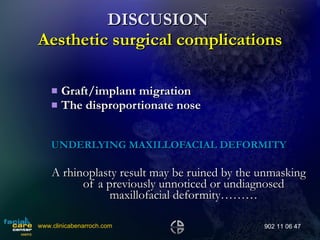 DISCUSION    Aesthetic surgical complications   Graft/implant migration The disproportionate nose UNDERLYING MAXILLOFACIAL DEFORMITY A rhinoplasty result may be ruined by the unmasking of a previously unnoticed or undiagnosed maxillofacial deformity……… www.clinicabenarroch.com 902 11 06 47 