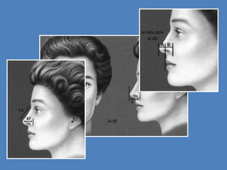 Rhinoplasty