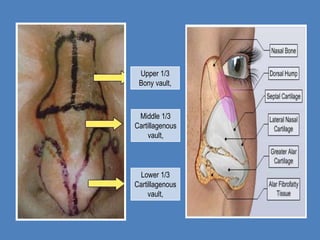 Upper 1/3
 Bony vault,



 Middle 1/3
Cartillagenous
    vault,



 Lower 1/3
Cartillagenous
    vault,
 