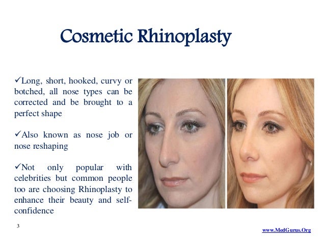 what is rhinoplasty