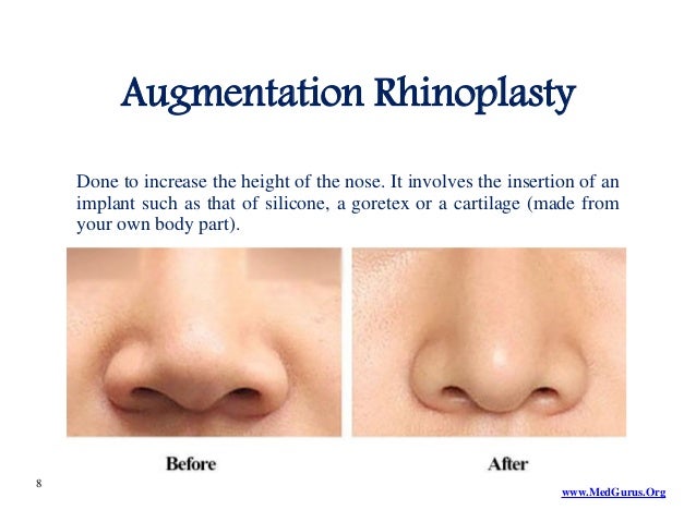 what is rhinoplasty