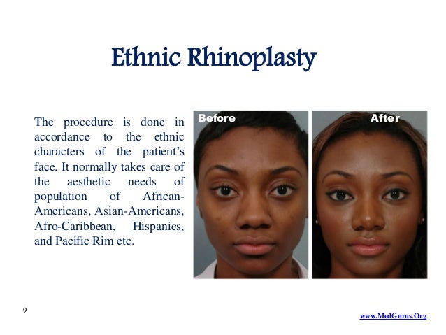 what is rhinoplasty