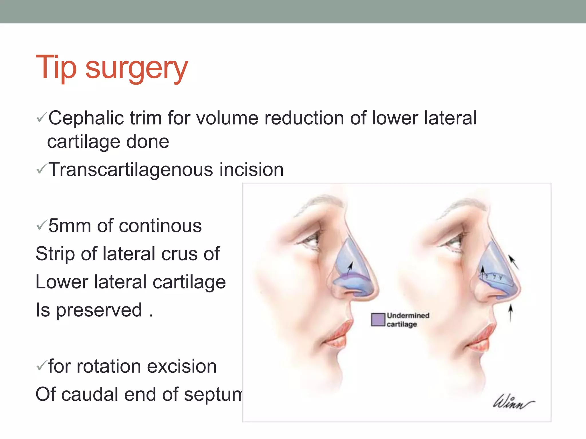 Rhinoplasty | PPTX