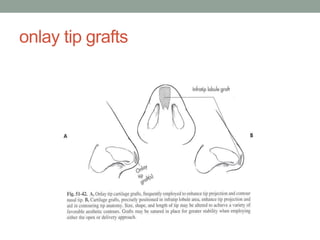 onlay tip grafts
 