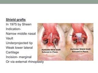 Shield grafts
In 1975 by Sheen
Indication-
Narrow middle nasal
Vault
Underprojected tip
Weak lower lateral
Cartilage
Incision- marginal
Or via external rhinoplasty
 