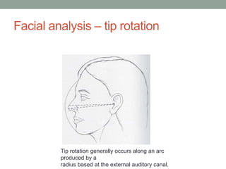 Facial analysis – tip rotation
Tip rotation generally occurs along an arc
produced by a
radius based at the external auditory canal.
 