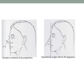Goode’s method of tip projection. Nasofacial angle (30 to 40 degrees).
 
