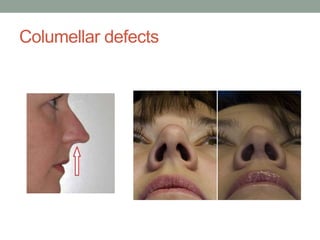 Columellar defects
 