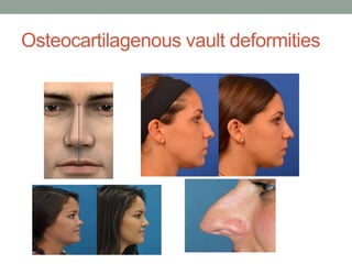 Osteocartilagenous vault deformities
 